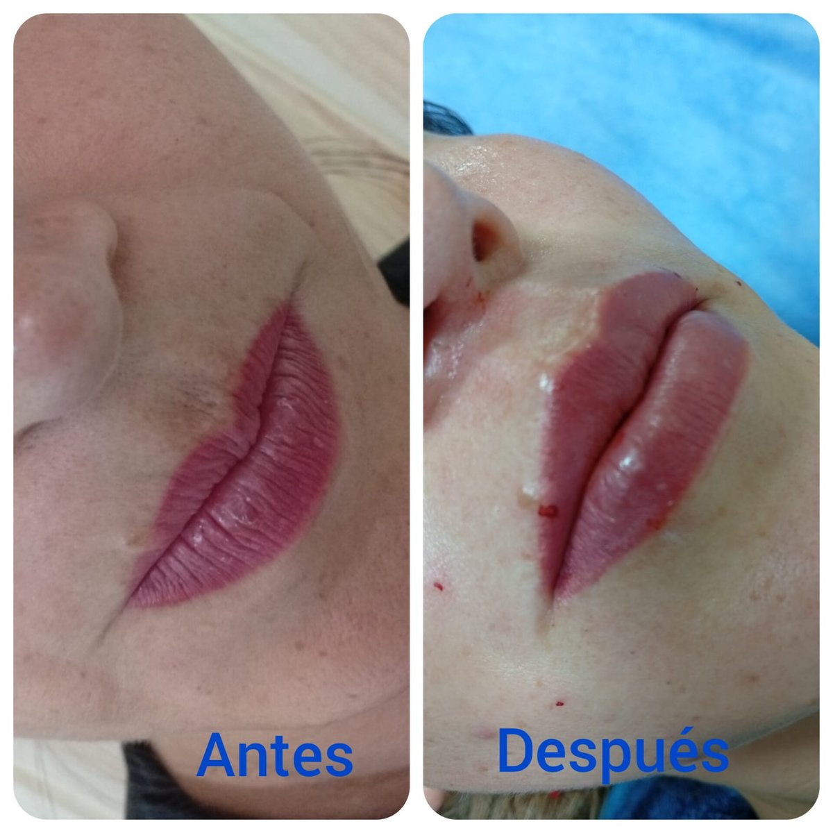 Aumento de labios · Filler hialurónico