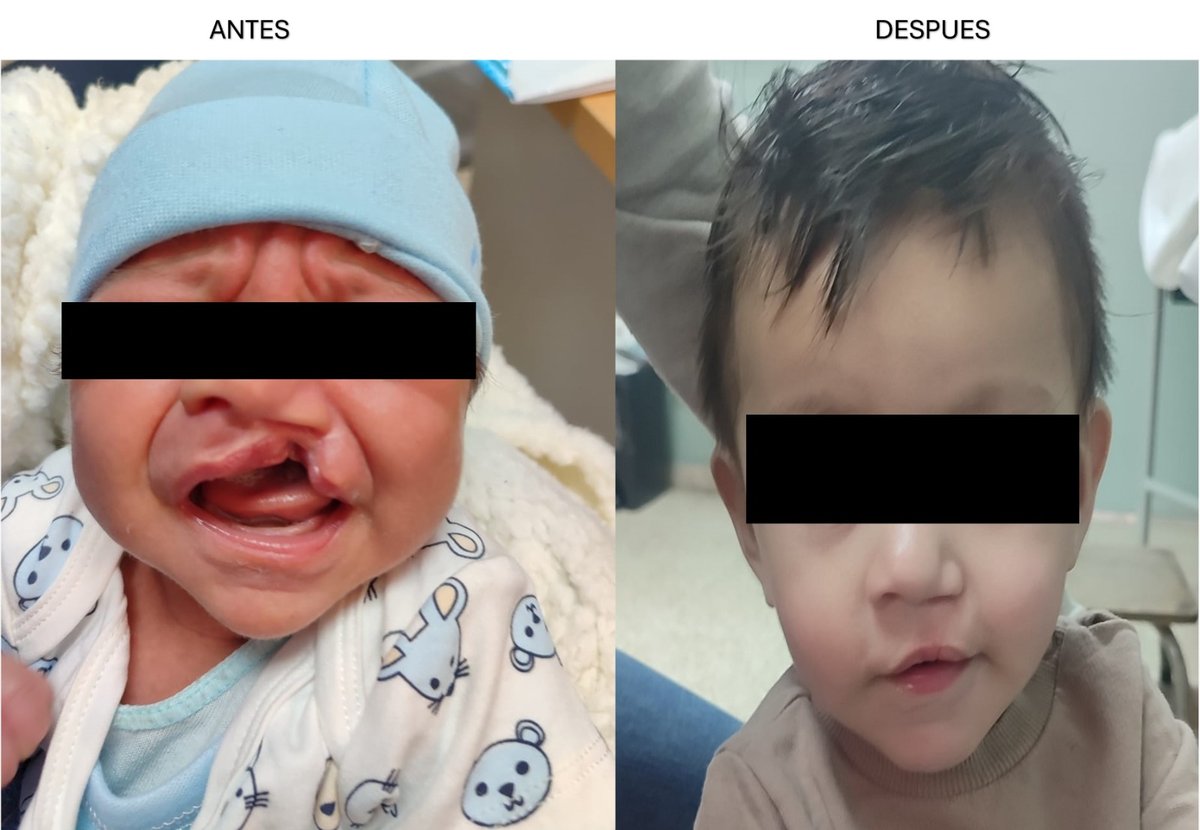 Reconstrucción de labio leporino · Cirugía reconstructiva pediátrica