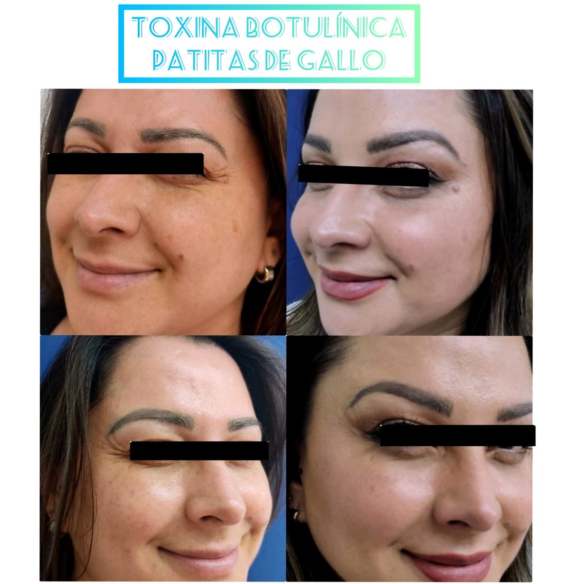 Bótox patas de gallo · Líneas perioculares